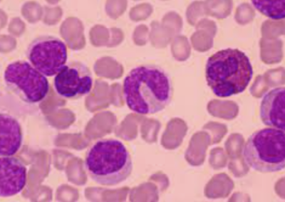 Priothera – FDA and EMA Grant Orphan Drug Designation to mocravimod for the treatment of Acute Myeloid Leukemia (AML) in patients undergoing allogeneic hematopoietic stem cell transplantation (HSCT)