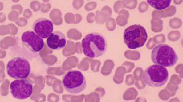 Priothera – FDA and EMA Grant Orphan Drug Designation to mocravimod for the treatment of Acute Myeloid Leukemia (AML) in patients undergoing allogeneic hematopoietic stem cell transplantation (HSCT)
