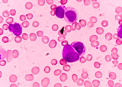 Priothera cleared to begin Japanese arm of pivotal Phase III study with mocravimod in patients with Acute Myeloid Leukemia undergoing allogeneic Hematopoietic Cell Transplant