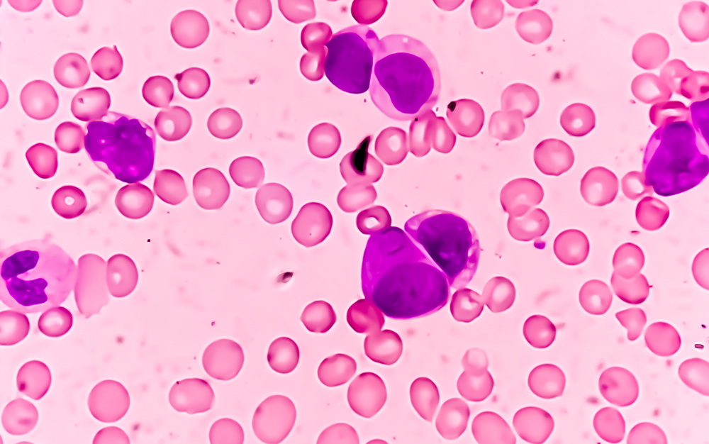 Priothera cleared to begin Japanese arm of pivotal Phase 3 study with mocravimod in patients with Acute Myeloid Leukemia undergoing allogeneic Hematopoietic Cell Transplant